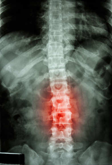 film x-ray T-L spine(Thoracic-Lumbar spine) show : human's thoracic-lumbar spine and inflammation at lumbar spine